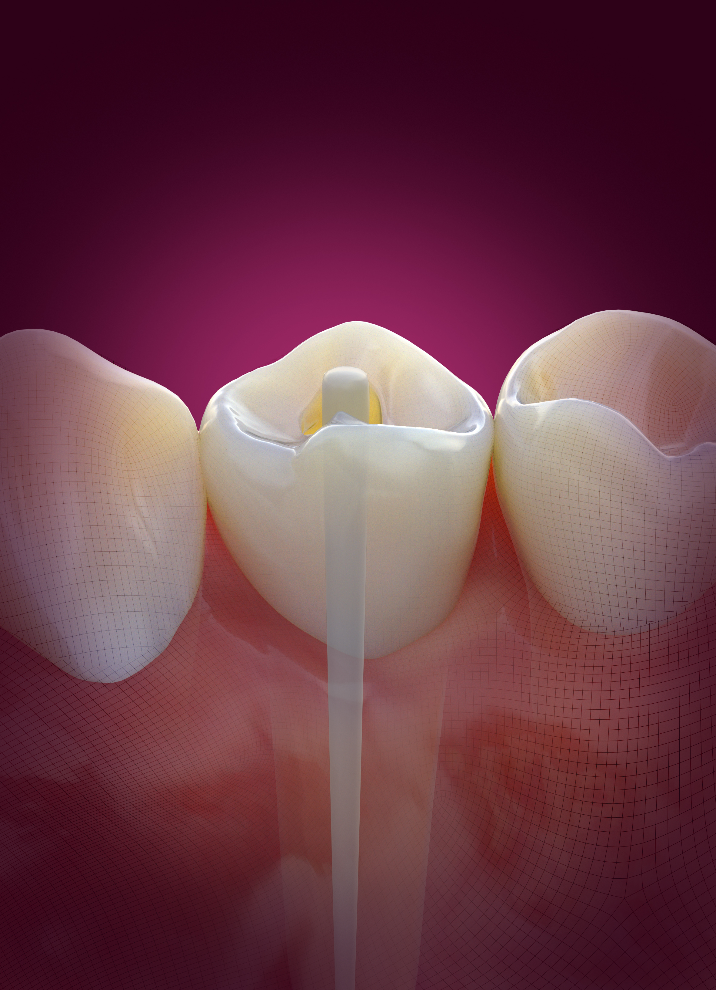 Endodontic Posts